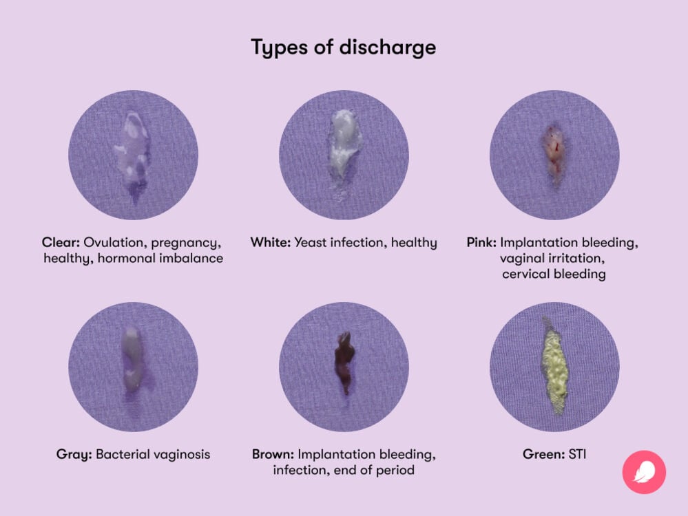 Types of vaginal discharge: What do they mean?